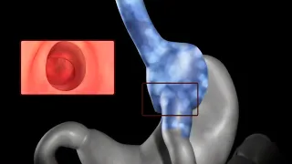Transoral Outlet Reduction Endoscopy - New York Bariatric Group
