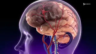 What is a Brain Aneurysm?