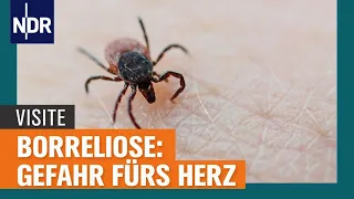 Borreliose: Eine Gefahr fürs Herz  | Visite | NDR