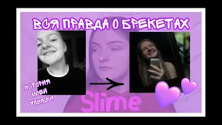 ВСЯ ПРАВДА О БРЕКЕТАХ//История моей улыбки💜