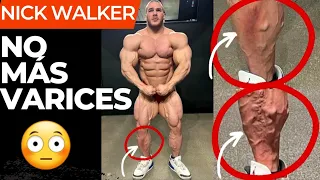 Nick Walker DESAPARECIÓ varices + Arnold Schwarzenegger NO LO PODRÁ CRITICAR MÁS.