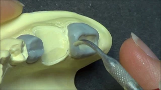 Live wax up - Lower Posterior bridge (contour1)