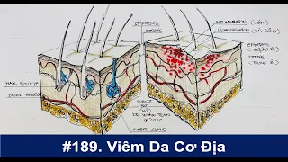 #189. Viêm da cơ địa chữa trị thế nào?