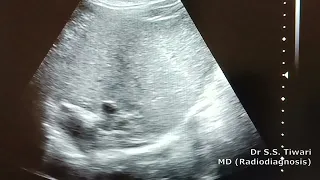 Chronic Liver Disease Ultrasound