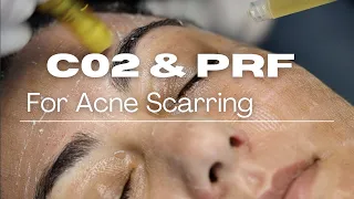 CO2 Laser and PRF Skincare Treatment Process