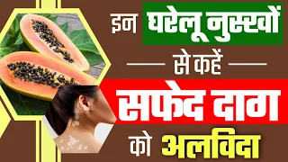 Top 5 Home Remedies To Cure Vitiligo | Safed Daag Ke Gharelu Upay | सफेद दाग का जड़ से इलाज