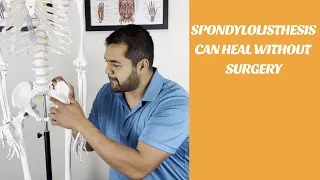 Lower Back Pain: Spondylolisthesis Can Heal Without Surgery | El Paso Manual Physical Therapy