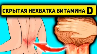 Их часто НЕ ЗАМЕЧАЮТ! Симптомы нехватки ВИТАМИНА D