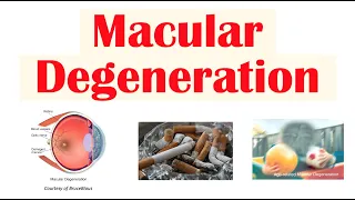 Macular Degeneration | Wet vs Dry | Risk Factors, Pathophysiology, Symptoms, Diagnosis, Treatment