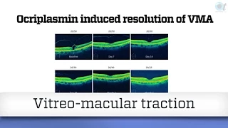 The new therapies for Vitreo-macular traction