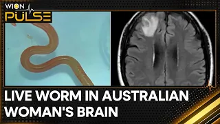 Australia doctors make shocking discovery, find living worm inside woman's brain | WION Pulse