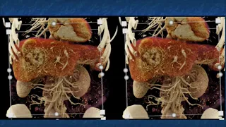 CT and CTA Evaluation of Hepatoma Part 1