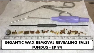 GIGANTIC EAR WAX REMOVAL REVEALING FALSE FUNDUS - EP 94