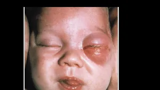 Case 654 How to approach for preorbital/ Orbital cellulitis?cefotaxime +Oxacillin ,cefotrixone + van