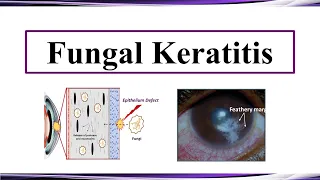 Fungal Keratitis