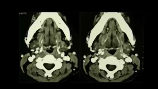 Imaging of Suprahyoid neck   DRE 12   Dr Mamdouh Mahfouz 720p