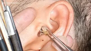 Ear Waxing vietnam (video 37)