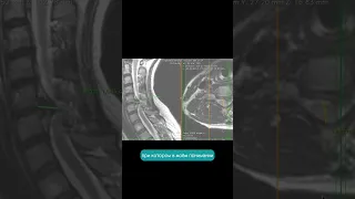 Грыжа шейного отдела позвоночника 11 мм. Разбор МРТ пациента
