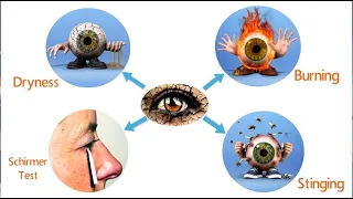 Dry Eye - Clinical Features and Investigation (Within 3.00 Mins) 3/4