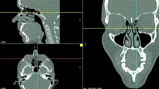 Curso de Tomografia do Nariz e Seios Paranasais