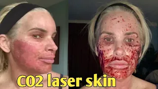 7-Day Journey My CO2 Laser Skin Resurfacing Experience – Before and after.. chris link