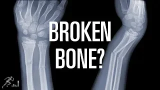 How to know if you broke a bone