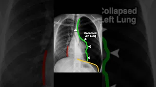 Grandma’s lung COLLAPSED after she fell down the stairs #medical #radiology