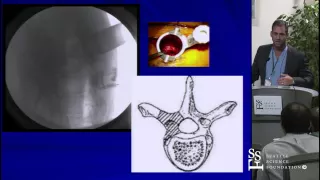 Lateral Approach to the Thoracic Spine by Adam Kanter, M.D.