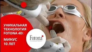 Лазерная подтяжка лица Fotona 4D: лифтинг эффект, омоложение кожи