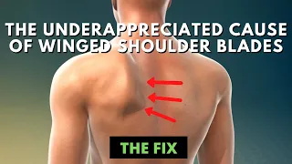 The Underrappreciated Cause of Winged Shoulder Blades - The Fix