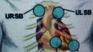 Pediatric heart murmurs