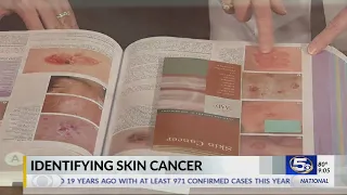VIDEO: How to identify skin cancer