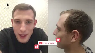 Результат пересадки волос через год - видео отзыв Дмитрия, восстановление макушки и передней части