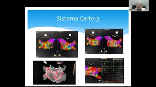 AISLAMIENTO DE VENAS PULMONARES EN FIBRILACIÓN AURICULAR PAROXÍSTICA - DR. ALEXANDER ÁLVAREZ