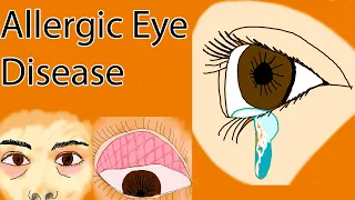 Allergic Eye disease - Allergic Conjunctivitis and Vernal keratoconjunctivitis