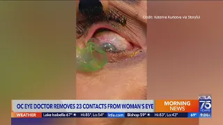 O.C. eye doctor removes 23 contacts from woman’s eye