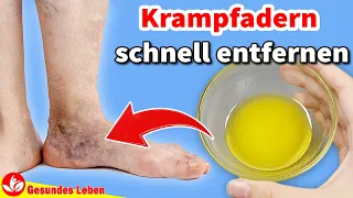 Reiben Sie dieses Öl auf Ihre Haut und die Krampfadern verschwinden im Handumdrehen