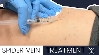 Sclerotherapy: The Gold Standard of Spider Vein Treatment