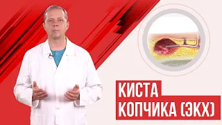 Киста копчика. Эпителиальный копчиковый ход.