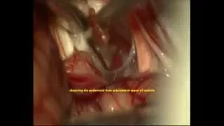 TRIGEMINAL NEURALGIA-C-P-ANGLE EPIDERMOID-endoscope- microsurgery-dr suresh dugani/HUBLI/INDIA