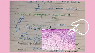 Oral Lichen Planus|| Notes