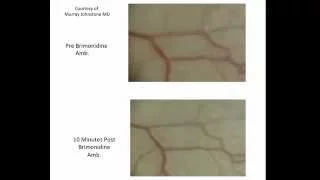 Video Brimonidine Causes Rapid Increase in Pulsatile Aqueous Outflow