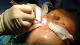 Asian blepharoplasty upper and lower (fat repositioning)