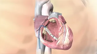 Implante de marcapasos endovascular MICRA