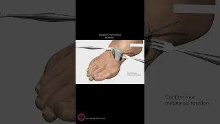 Lapiplasty® surgical Technique Animation - #shorts