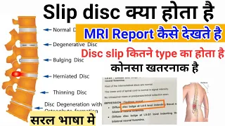 Slip disc (disc prolapse) क्या होता है|| स्लिप डिस्क कितने type की होती है ||MRI report कैसे देखेंगे