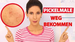 Aknemale entfernen - Pickelmale loswerden - Die 5 besten Tipps 👍