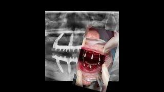 All on 4 / All on four - протезирование всех зубов на 4 имплантах за 1 день с постоянным протезом