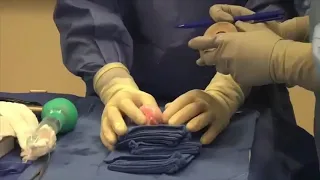 Cartilage Transplant with Fresh Donated Osteochondral Allograft