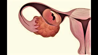 Внематочная беременность с сохранением маточной трубы